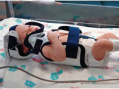 Papoose Infant Immobilizer