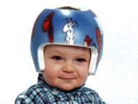 Boston Band for Plagiocephaly (Product View) 